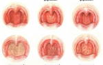 Фарингит бактериальный как лечить