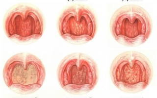 Фарингит бактериальный как лечить