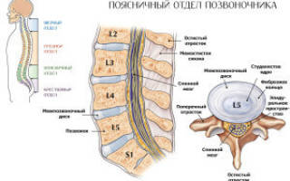Межпозвоночная грыжа поясничного отдела симптомы и лечение