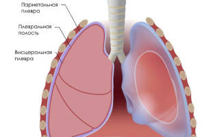 Плевральная шварта что это такое