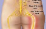 Какие мази помогают при защемлении седалищного нерва