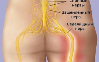 Какие мази помогают при защемлении седалищного нерва